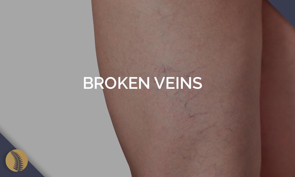 Broken Veins Condition Image Link